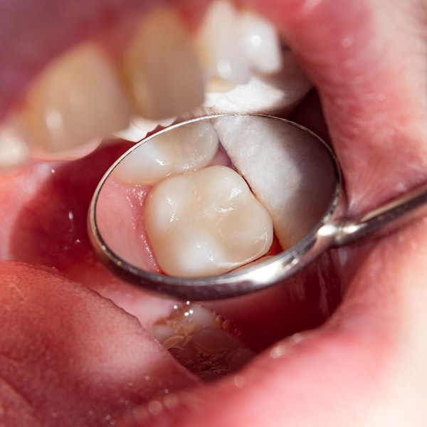 Close up of a tooth-colored composite filling