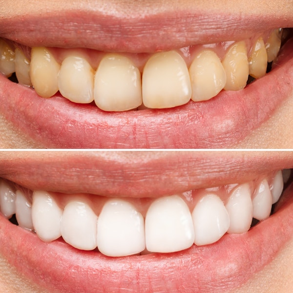 Before and after veneers