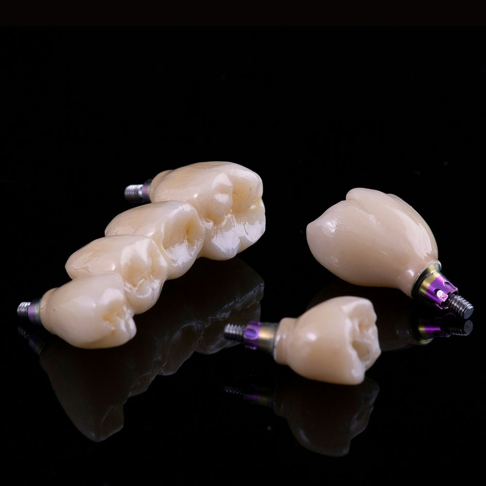 dental implant-supported restorations