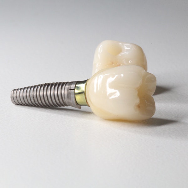 Dental implants