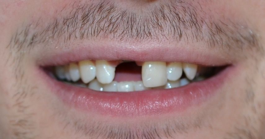 Before dental treatments
