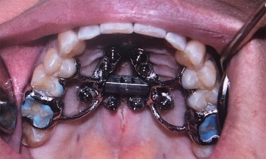 MARPE in someone's mouth