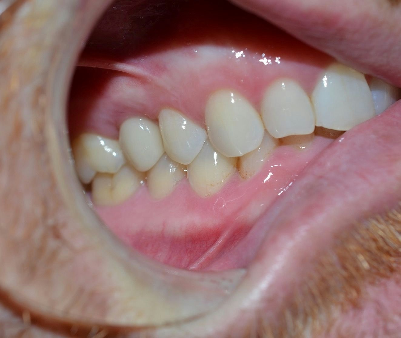 Dental implant After image