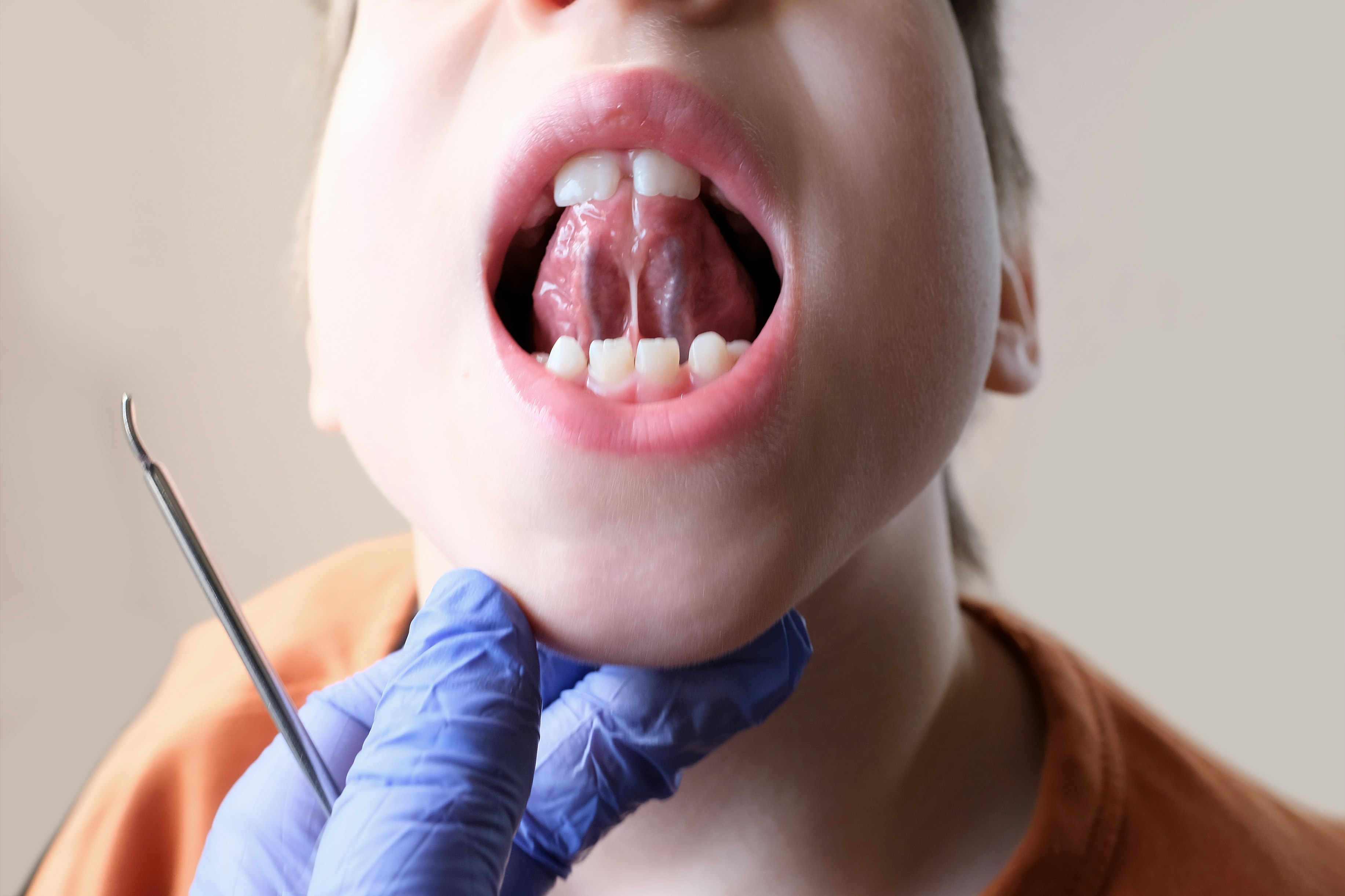 Young patient with tongue tie