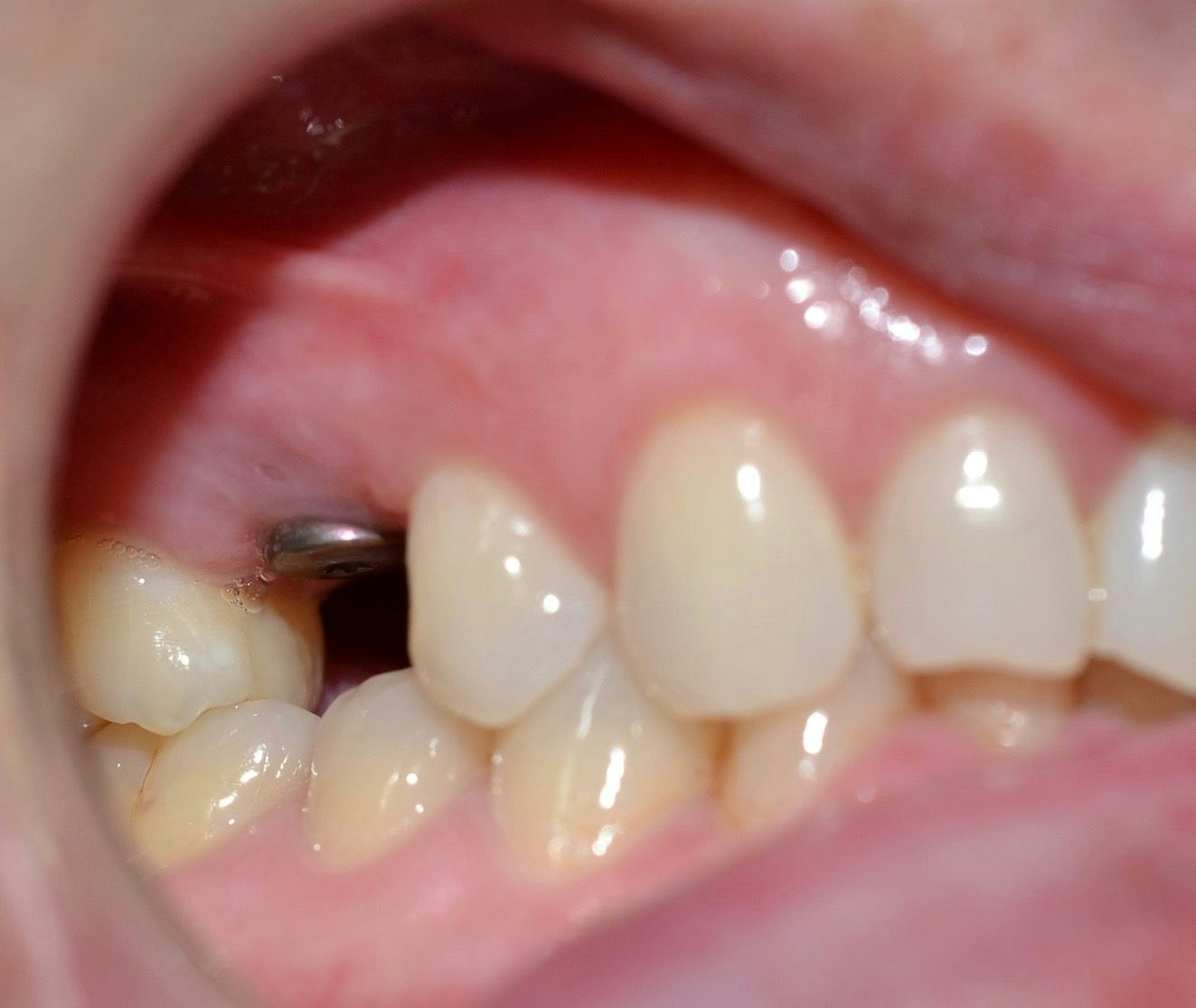 Dental Implant Before image