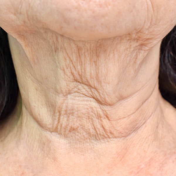 Loose and wrinkled skin around the neck and chin