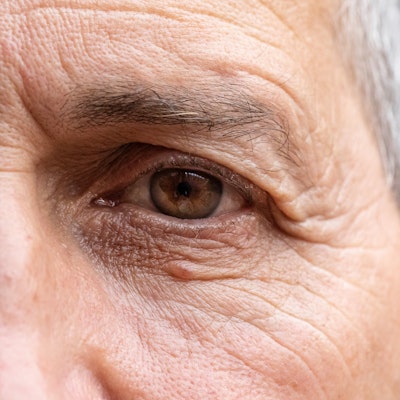 Drooping eyebrows