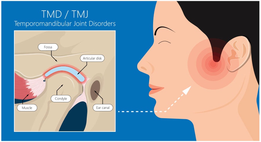Illustration of the TMJ joint anatomy