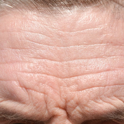 Forehead lines