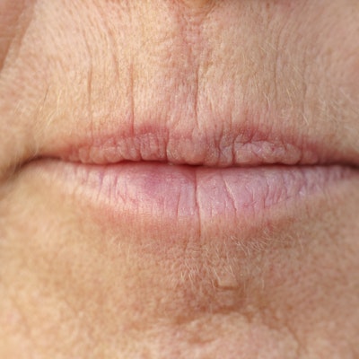 Lip lines