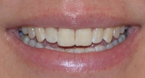 No Gap Before MARPE treatment