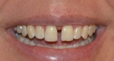 Gapped front teeth after MARPE expander