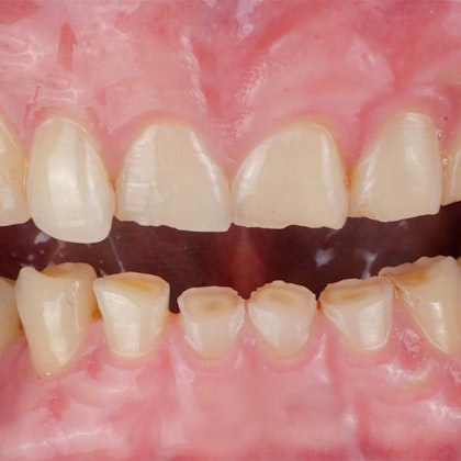 Worn teeth showing signs of bruxism and teeth grinding