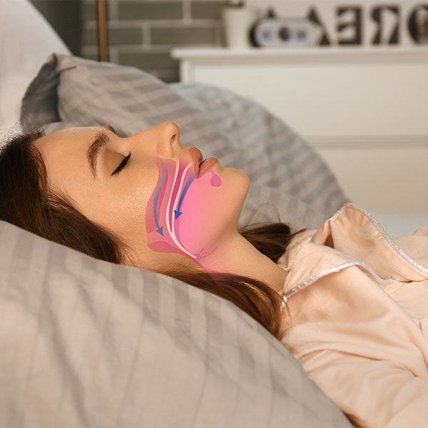 Woman sleeping with illustration of OSA