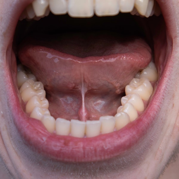 tongue tied