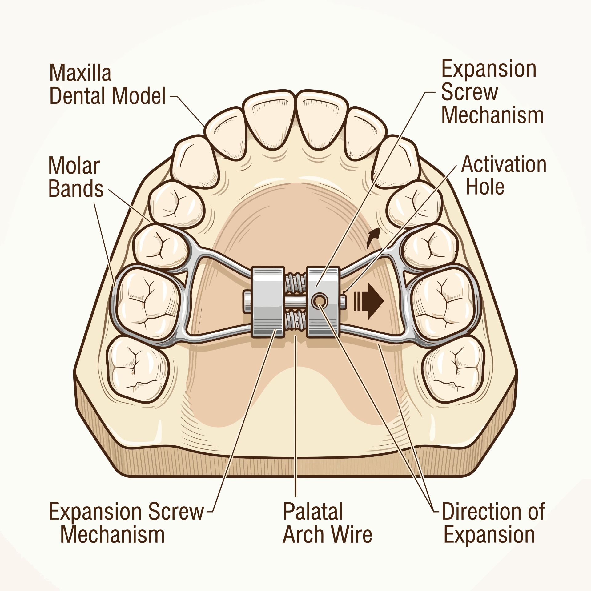 Labeled diagram of a palatal expander on an upper dental model, showing molar bands and the central expansion screw