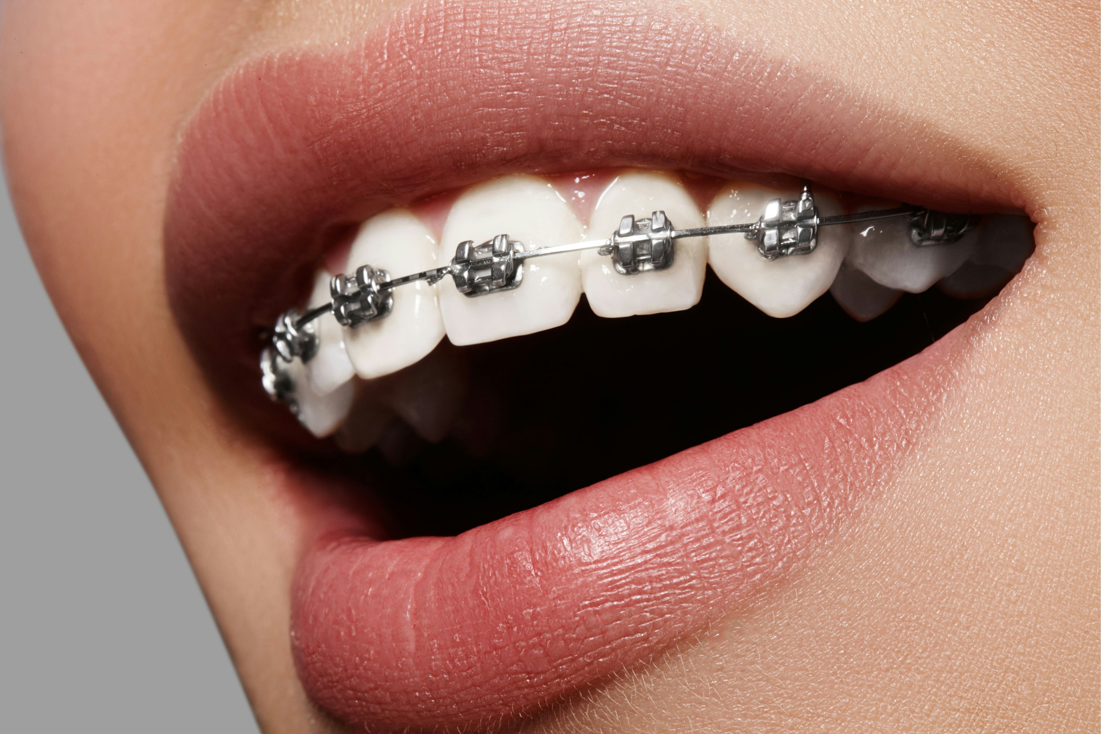 Close up of braces