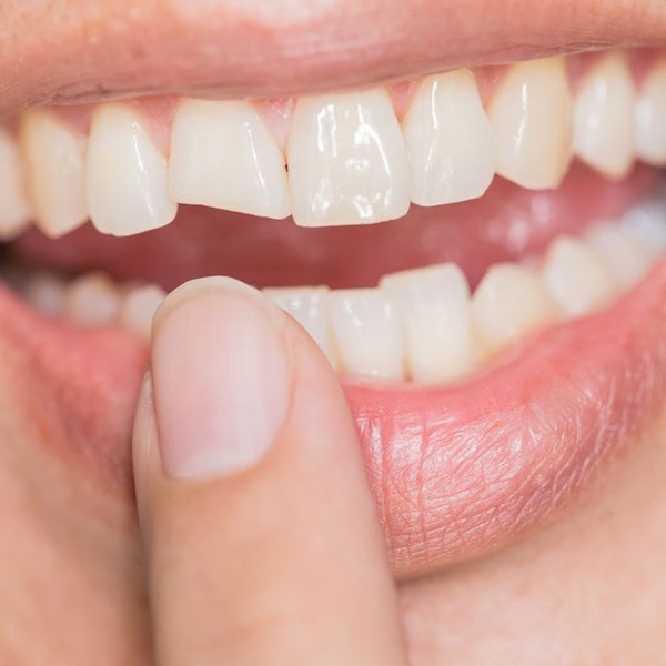 Close up of tooth chip