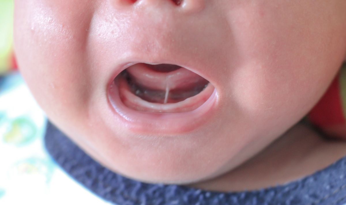 Close up showing tongue tie frenulum restriction in infant