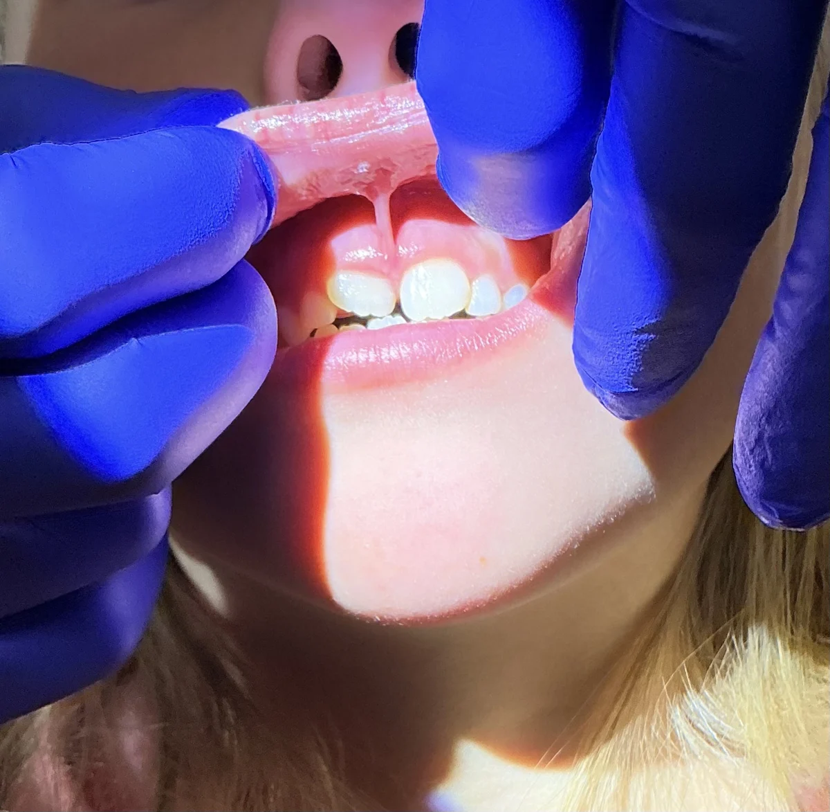 Close-up of an oral frenulum examination at Peak Family Dentistry