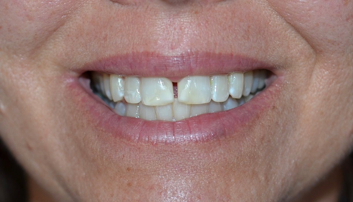 Before dental treatments
