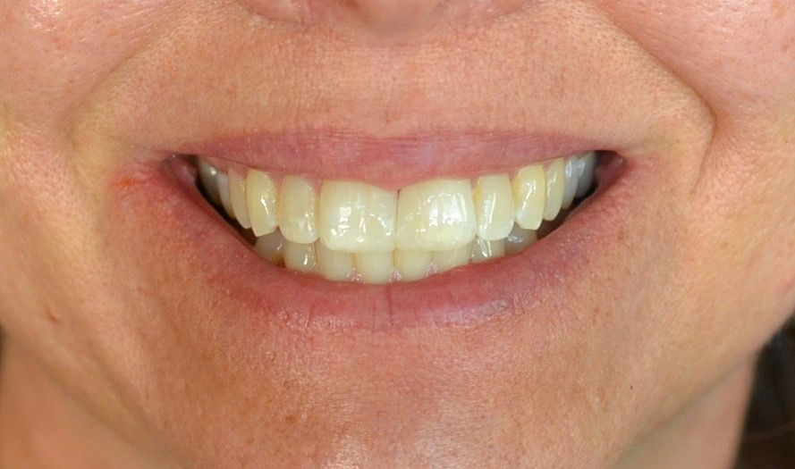After dental treatments