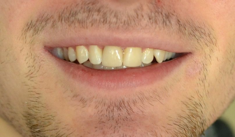 After dental treatments