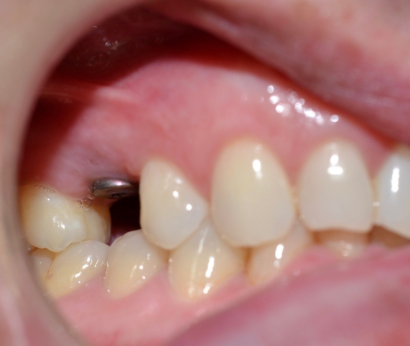 Before dental treatments